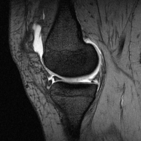 File:Bucket handle tear - medial meniscus (Radiopaedia 79028-91942 D 17).jpg