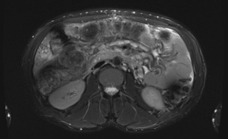 File:Budd Chiari syndrome (Radiopaedia 70299-80375 Axial T2 fat sat 28).jpg