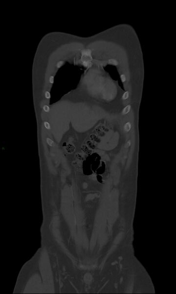 File:Burst fracture (Radiopaedia 83168-97542 Coronal bone window 16).jpg