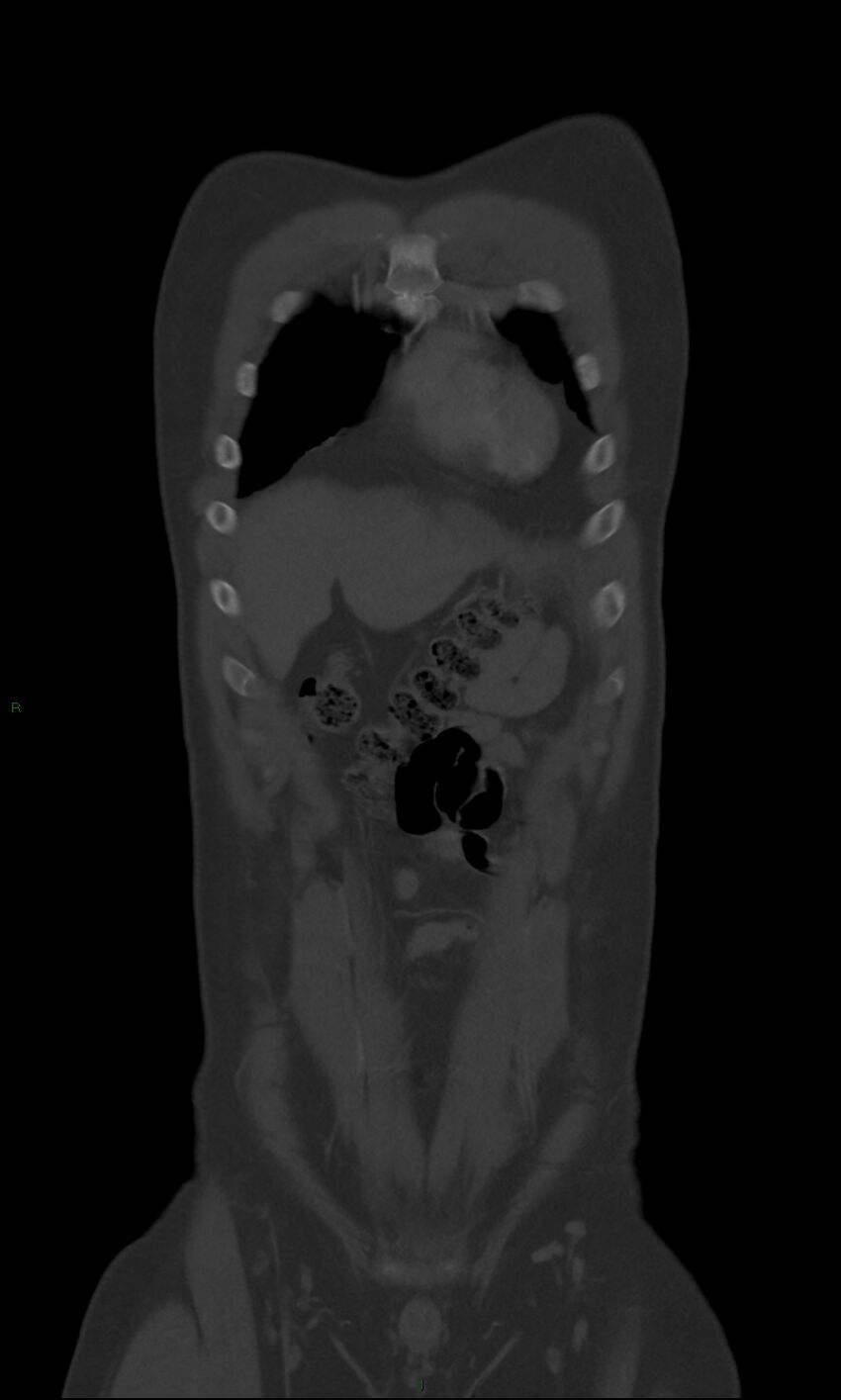 Burst fracture (Radiopaedia 83168-97542 Coronal bone window 16).jpg