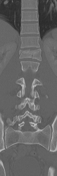 File:Burst fracture - T12 with conus compression (Radiopaedia 56825-63647 Coronal bone window 22).png