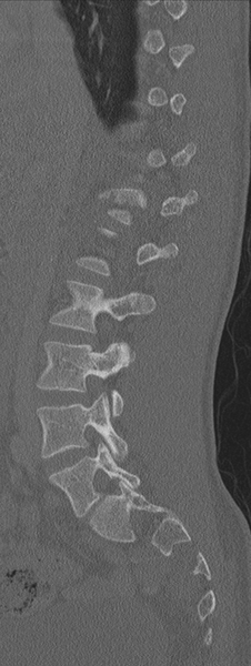 File:Burst fracture - T12 with conus compression (Radiopaedia 56825-63647 Sagittal bone window 55).png