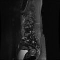 Burst fracture - lumbar spine (Radiopaedia 72877-83541 Sagittal STIR 9).jpg