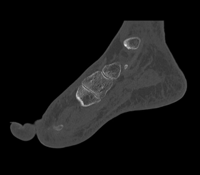 File:Calcaneal tuberosity avulsion fracture (Radiopaedia 22649-22668 Sagittal bone window 37).jpg