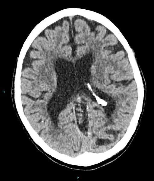 File:Calcified cerebral emboli from left ventricular thrombus (Radiopaedia 84420-99758 Axial non-contrast 44).jpg