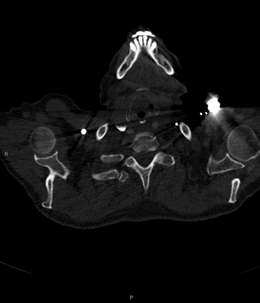 File:Calcified cerebral emboli from left ventricular thrombus (Radiopaedia 84420-99760 Axial bone window 1).jpg