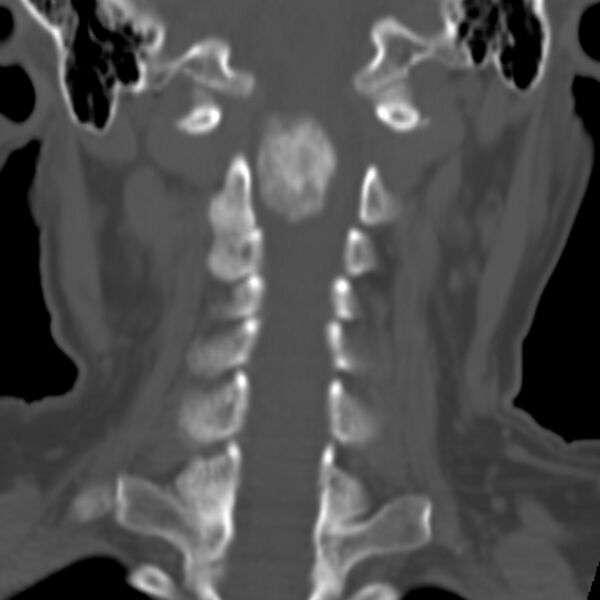 File:Calcified meningioma - cervical canal (Radiopaedia 70136-80171 Coronal bone window 16).jpg