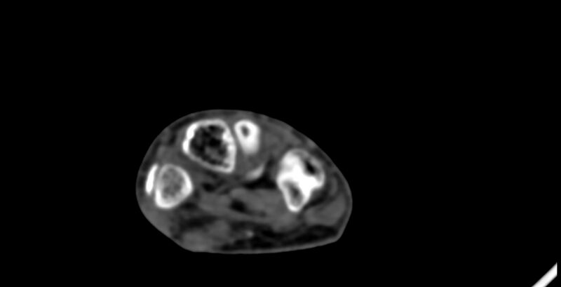 File:Calcifying aponeurotic fibroma (Radiopaedia 88423-105064 B 116).jpg
