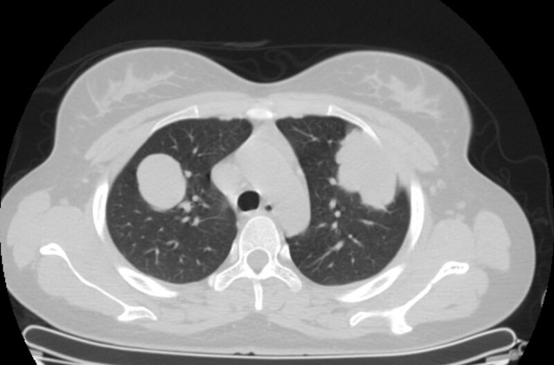 File:Cannonball metastases - uterine choriocarcinoma (Radiopaedia 70137-80173 Axial lung window 18).jpg