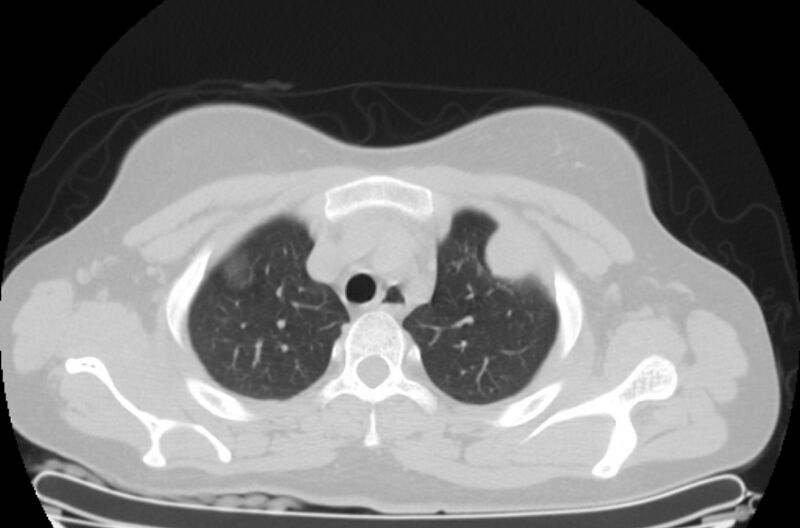 File:Cannonball metastases - uterine choriocarcinoma (Radiopaedia 70137-80173 Axial lung window 7).jpg