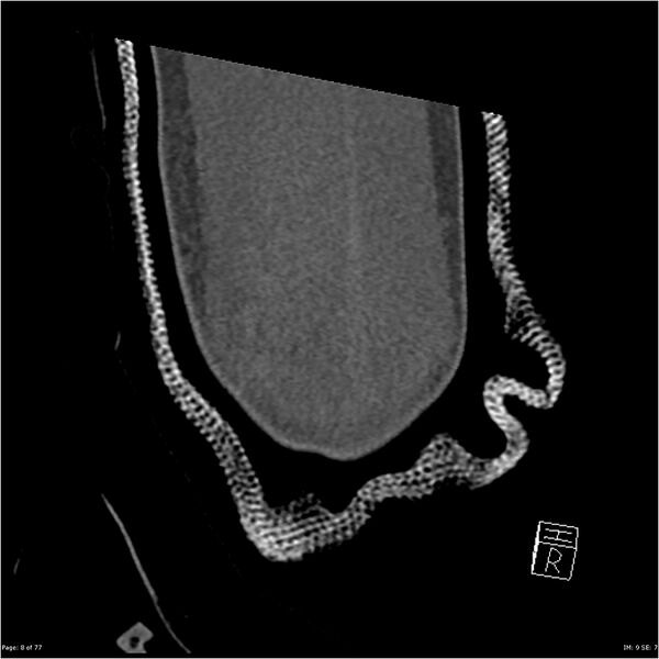 File:Capitellum fracture (Radiopaedia 23352-23426 Coronal bone window 8).jpg