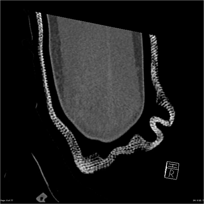 Capitellum fracture (Radiopaedia 23352-23426 Coronal bone window 8).jpg