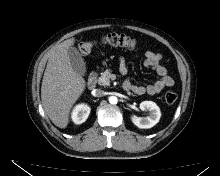 Carcinoid tumor with hepatic metastases (Radiopaedia 22651-22670 B 32).jpg