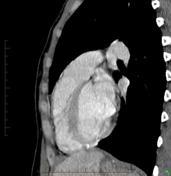 File:Cardiac paraganglioma (Radiopaedia 76345-88005 C 35).jpg