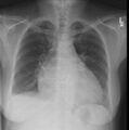 Cardiomegaly (Radiopaedia 11279-11643 Frontal 1).jpg