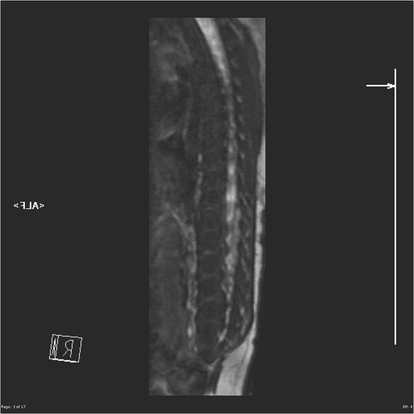File:Caudal regression syndrome (Radiopaedia 23610-23727 Sagittal CISS 3).jpg