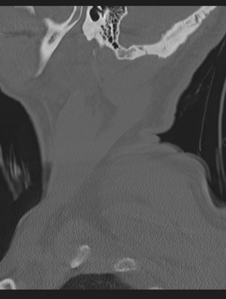 File:Cavernoma of cervical cord (Radiopaedia 50838-56346 Sagittal bone window 5).png