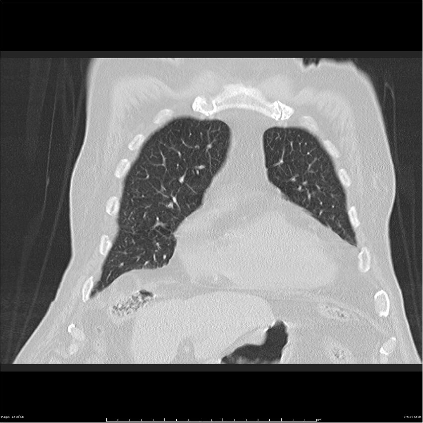 Cavitating left lower lobe lesion - squamous cell lung cancer (Radiopaedia 27749-28176 Coronal lung window 13).jpg