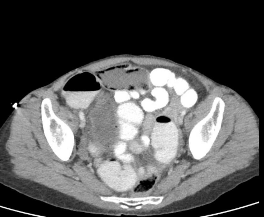 Cecal volvulus with pneumatosis coli (Radiopaedia 68572-78178 A 104).jpg