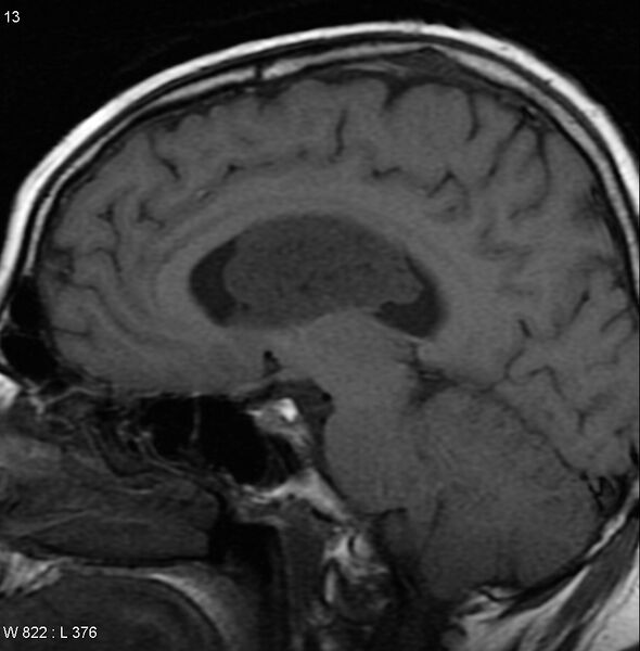 File:Central neurocytoma (Radiopaedia 4956-6850 Sagittal T1 1).jpg