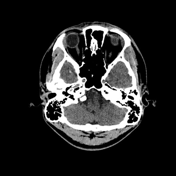 File:Central neurocytoma (Radiopaedia 79320-92379 Axial non-contrast 9).jpg