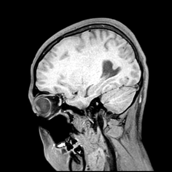 File:Central neurocytoma (Radiopaedia 79320-92380 Sagittal T1 81).jpg