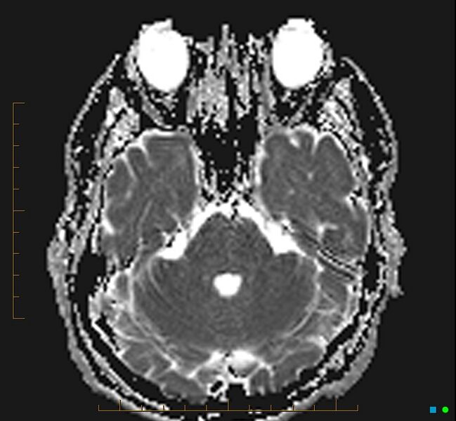 File:Cerebellar gangliocytoma (Radiopaedia 65377-74422 Axial ADC 11).jpg