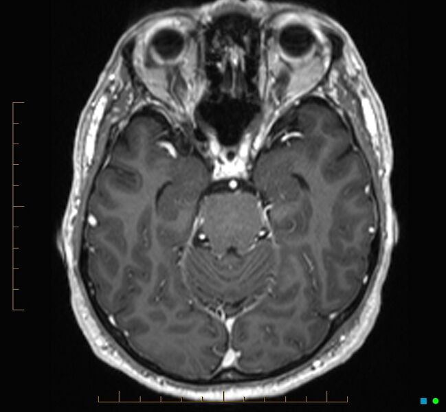 File:Cerebellar gangliocytoma (Radiopaedia 65377-74422 Axial T1 C+ 44).jpg