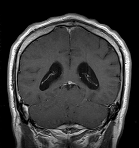 File:Cerebellopontine angle meningioma (Radiopaedia 24459-24764 Coronal T1 C+ 17).jpg