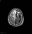 Cerebral abscesses secondary to contusions (Radiopaedia 5201-6968 Axial FLAIR 10).jpg