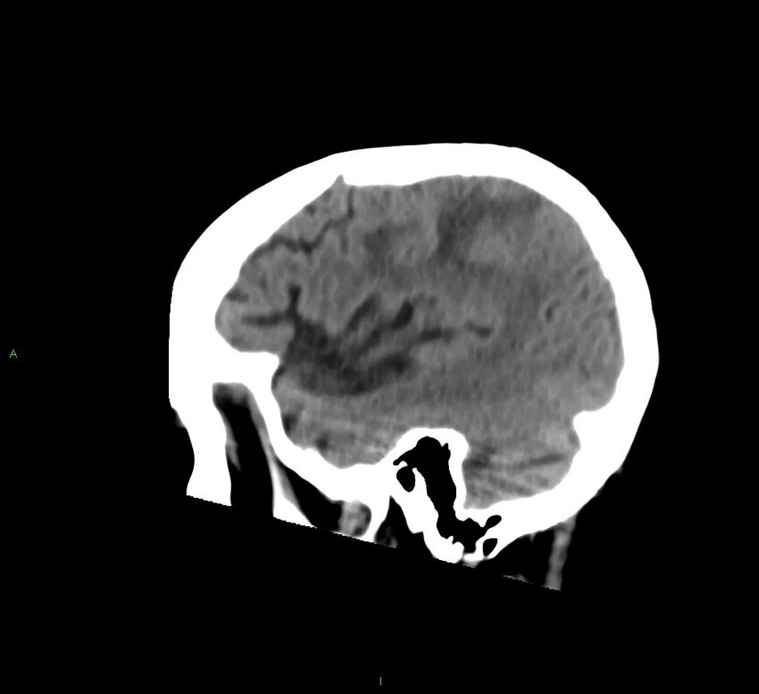Cerebral amyloid angiopathy-associated lobar intracerebral hemorrhage (Radiopaedia 58530-65688 C 43).jpg