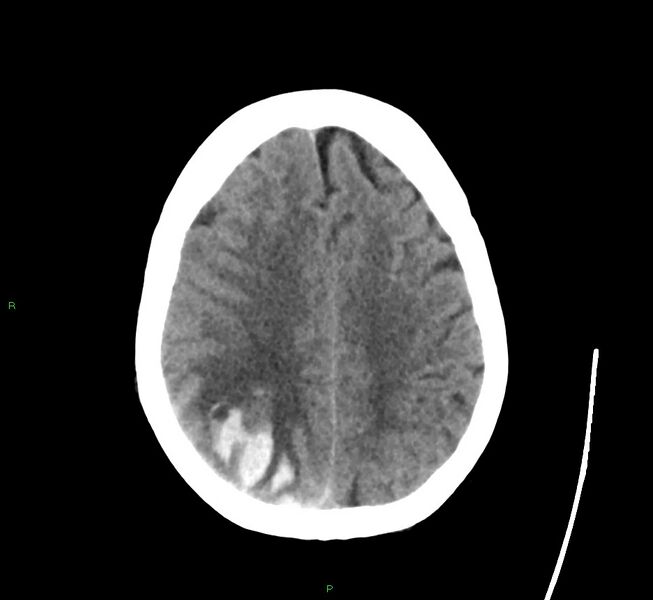 File:Cerebral amyloid angiopathy-associated lobar intracerebral hemorrhage (Radiopaedia 58563-65727 Axial non-contrast 18).jpg