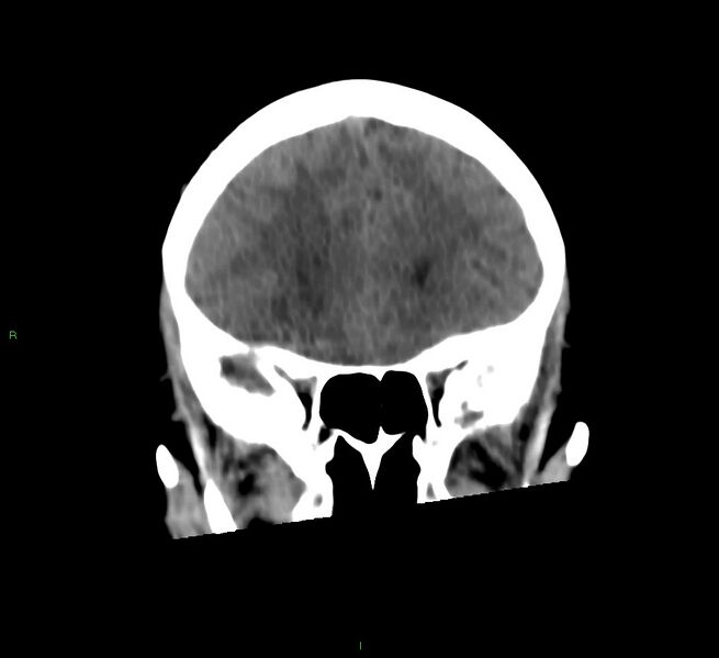 File:Cerebral amyloid angiopathy-associated lobar intracerebral hemorrhage (Radiopaedia 58566-65730 Coronal non-contrast 50).jpg