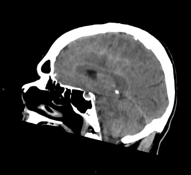 File:Cerebral amyloid angiopathy-associated lobar intracerebral hemorrhage (Radiopaedia 58756-65977 C 32).jpg