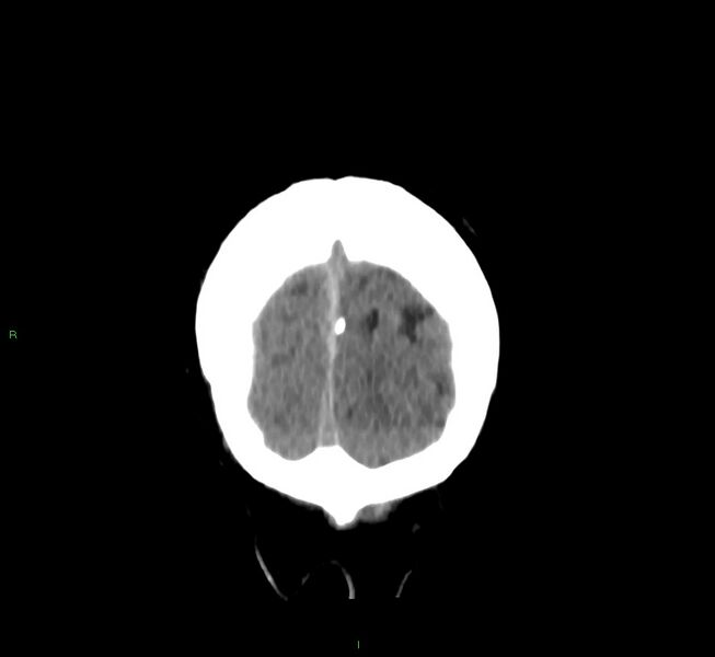 File:Cerebral amyloid angiopathy-associated lobar intracerebral hemorrhage (Radiopaedia 58756-65977 Coronal non-contrast 9).jpg