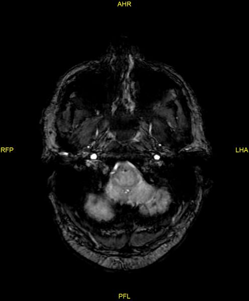 File:Cerebral autosomal dominant arteriopathy with subcortical infarcts and leukoencephalopathy (CADASIL) (Radiopaedia 86108-102054 Axial SWI 15).jpg