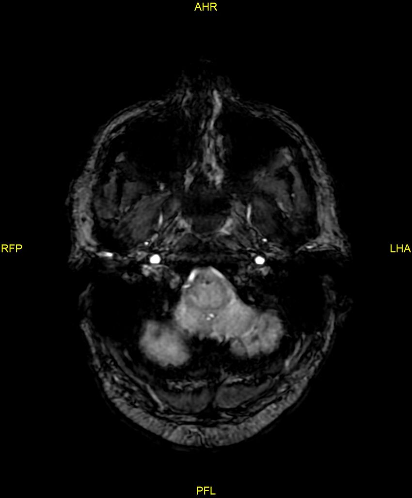 Cerebral autosomal dominant arteriopathy with subcortical infarcts and leukoencephalopathy (CADASIL) (Radiopaedia 86108-102054 Axial SWI 15).jpg