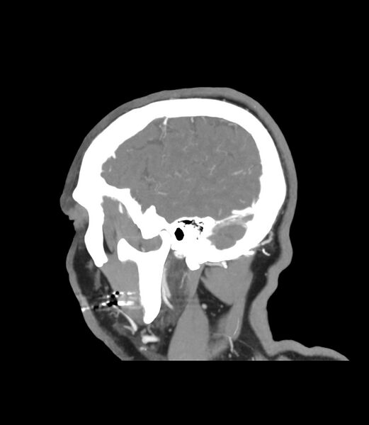 File:Cerebral dural venous sinus thrombosis (Radiopaedia 86514-102576 C 51).jpg
