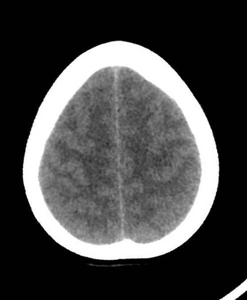 File:Cerebral edema due to severe hyponatremia (Radiopaedia 89826-106937 Axial non-contrast 76).jpg