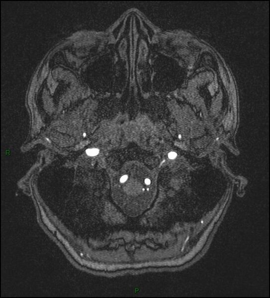File:Cerebral fat embolism (Radiopaedia 35022-36525 Axial TOF 13).jpg