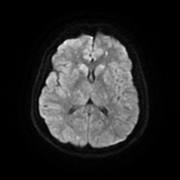 File:Cerebral fat embolism (Radiopaedia 37510-39363 Axial DWI 15).jpg