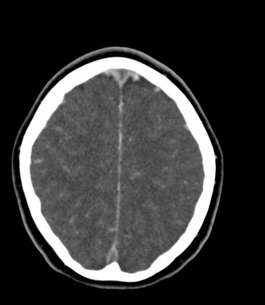 File:Cerebral venous sinus thrombosis (Radiopaedia 59224-66646 Axial C+ delayed 13).jpg