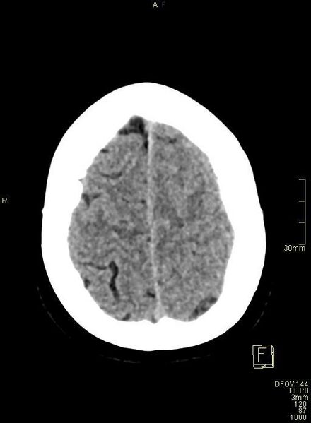 File:Cerebral venous sinus thrombosis (Radiopaedia 91329-108965 Axial non-contrast 43).jpg