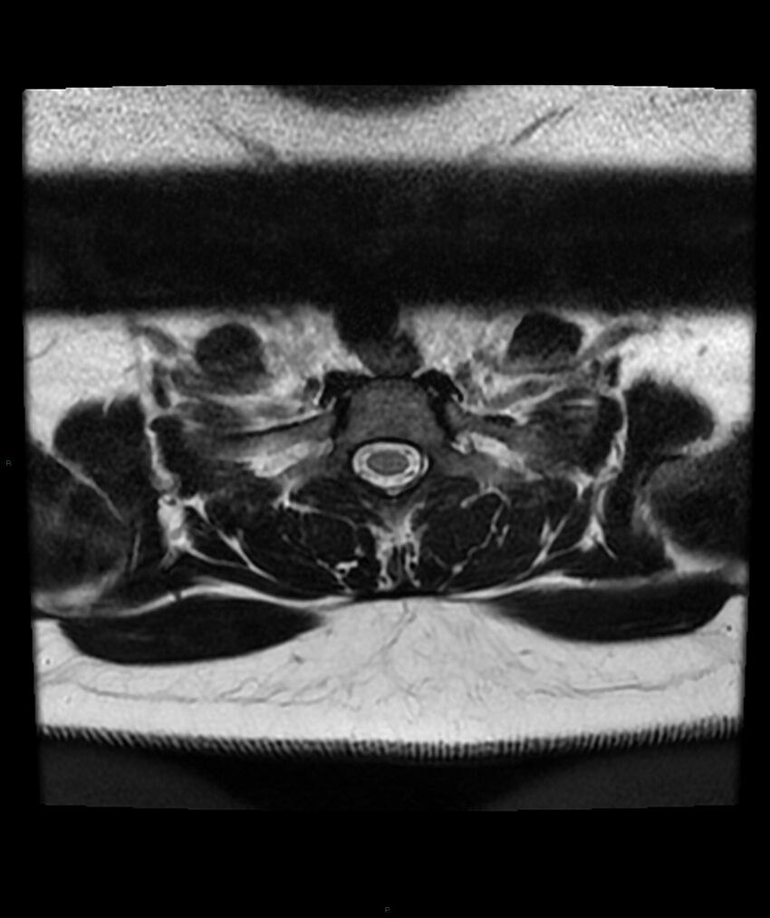 Cervical disc prolapse (Radiopaedia 80258-93598 Axial T2 79).jpg