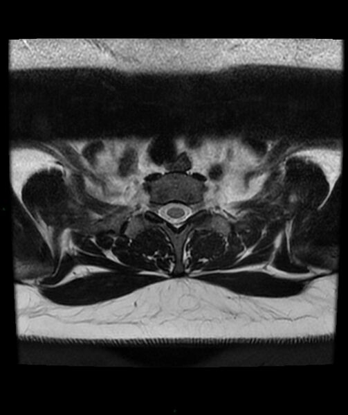 File:Cervical disc prolapse (Radiopaedia 80258-93598 Axial T2 90).jpg