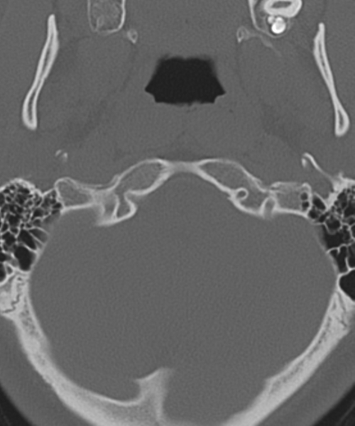 File:Cervical intercalary bone (Radiopaedia 35211-36748 Axial bone window 8).png