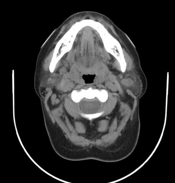 File:Cervical lymphadenopathy- cause unknown (Radiopaedia 22420-22457 non-contrast 30).jpg