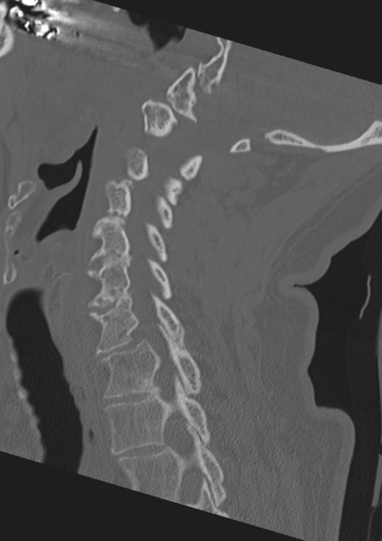 File:Cervical spine fractures with vertebral artery dissection (Radiopaedia 53296-59268 Sagittal bone window 27).png