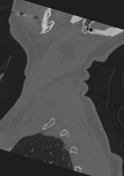 File:Cervical spine fractures with vertebral artery dissection (Radiopaedia 53296-59268 Sagittal bone window 67).png