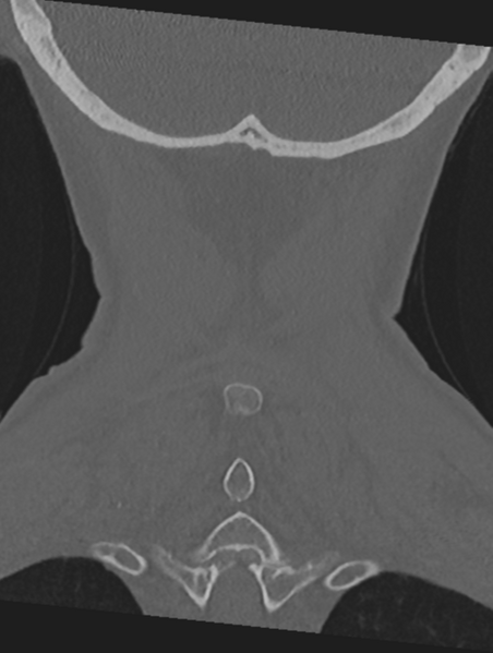 File:Cervical spondylolysis (Radiopaedia 49616-54811 Coronal bone window 52).png